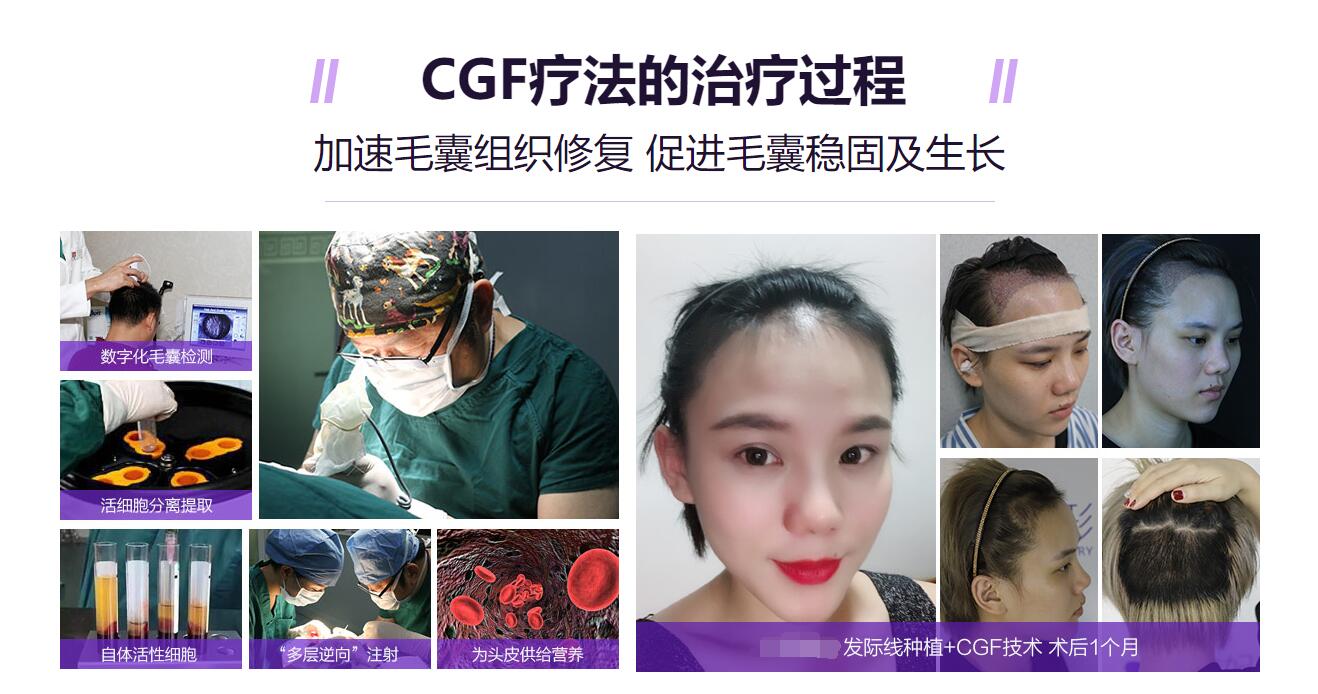 CGF生发、CGF植发，CGF注射疗法，效果怎么样？