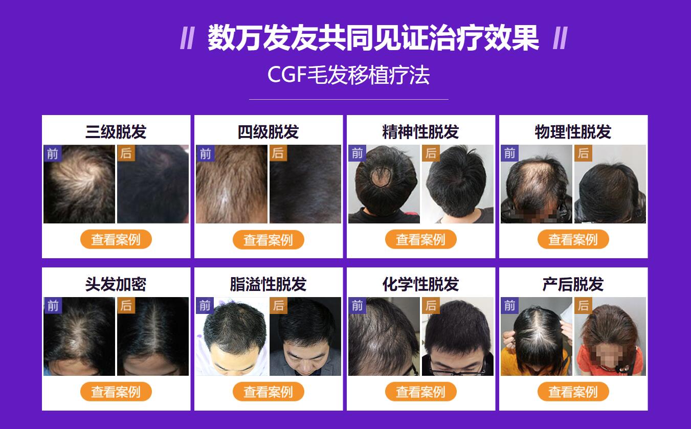 CGF生发、CGF植发，CGF注射疗法，效果怎么样？