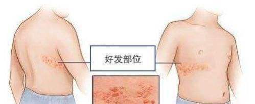 带状疱疹千万不要忽视，找南京肤康皮肤病研究所